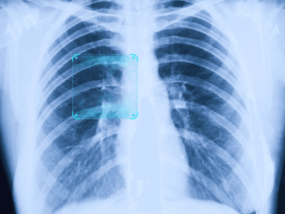肺结节图像识别