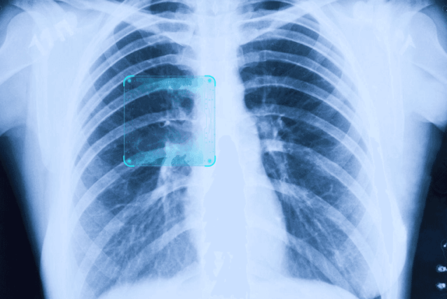 肺结节图像识别